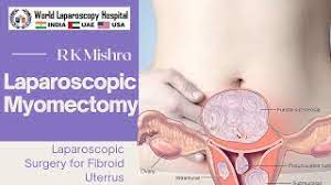 Laparoscopic Management of Intramural Fibroid