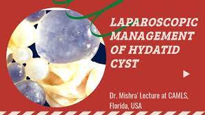Dr. Mishra's Lecture on Laparoscopic Management of Hydatid Cyst at CAMLS, USF, Florida
