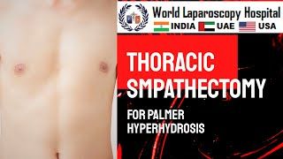 Thoracic Sympathectomy for Palmar Hyperhidrosis