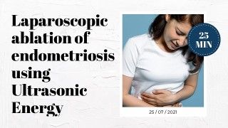 Laparoscopic ablation of endometriosis using Ultrasonic Energy