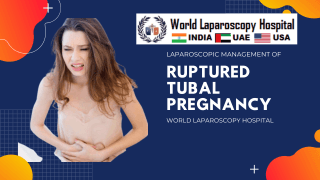 Laparoscopic Surgery for Ruptured Tubal Pregnancy