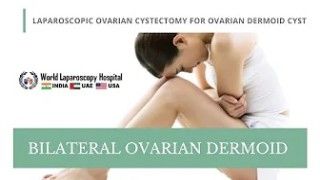 Bilateral Ovarian Dermoid Dermoid Cyst