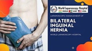 Bilateral Inguinal Hernia with Left sided Sliding Inguinal Hernia