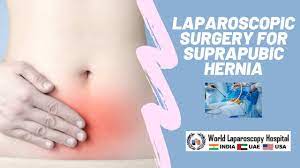 Recurrent Hernia Laparoscopic Repair