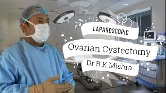 How to perform safe Dermoid Ovarian Cystectomy without Spillage