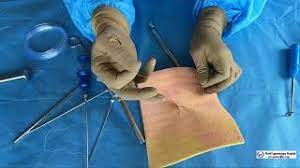 Laparoscopic Bilateral Inguinal Hernia Repair