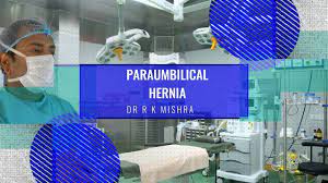 Suprapubic Incisional Hernia Repair