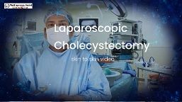 Laparoscopic Hysterectomy for Multiple Fibroid and Endometrioma