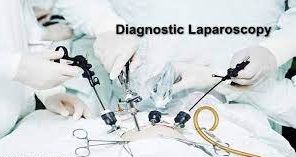 Diagnostic Laparoscopy Ovarian Drilling for PCOD and Tubal Patency Test