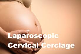 Laparoscopic Cervical Cerclage