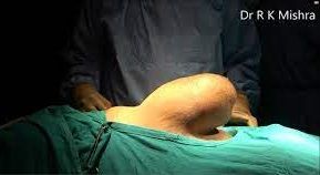 Laparoscopic Management of Posterior Intramural Fibroid