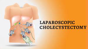 Laparoscopic Management of Small Bowel Adhesion