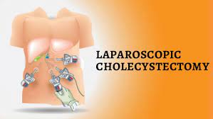 Laparoscopy Hysterectomy