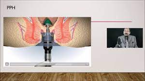 Total laparoscopic hysterectomy (TLH) in patients with previous cesarean section