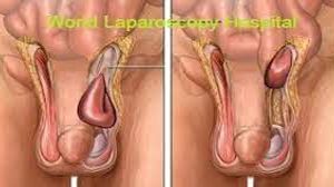 Dr R K Mishra Explaining Laparoscopic Cholecystectomy