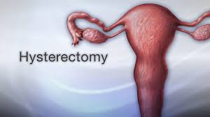 Unedited Laparoscopic Hysterectomy - Dr. R. K. Mishra