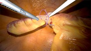 Laparoscopic Hysterectomy And Appendectomy Using Illuminated Ureteral Stent Step Step Demonstration