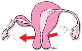 Rudimentary Uterus