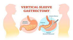 Obesity Surgery Sleeve Gastrectomy Lecture by Dr R K Mishra