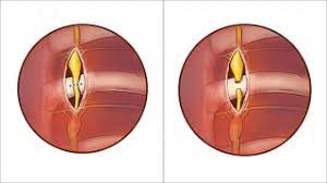 Myomectomy and Dermoid Ovarian Cystectomy