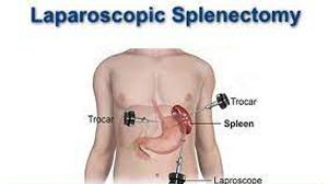 Laparoscopic Myomectomy for Intramural Fibroid