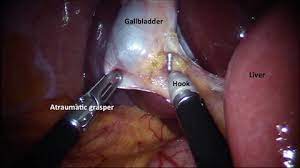 Laparoscopic Repair of Incisional Hernia: A Detailed Surgical Procedure by Dr. R.K. Mishra