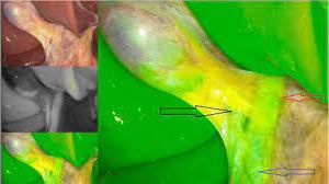 Total Laparoscopic Hysterectomy with Sacrocolpopexy