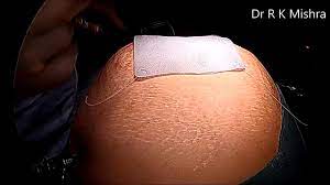 Learn about Laparoscopic Hernia Surgery from Dr R K Mishra and Poonam Dhillon