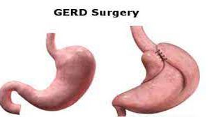 Laparoscopic myomectomy instead of hysteroscopic myomectomy for large submucous fibroid.