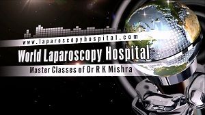 Total Laparoscopic Hysterectomy by Ligation of Uterine artery