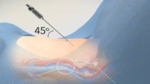 Laparoscopic Bilateral Salpingectomy