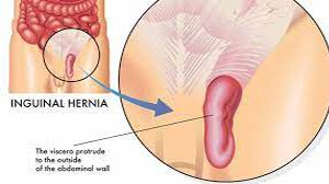 Laparoscopic Inguinal Hernia Surgery Explained Step by Step