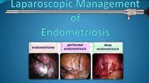 Sacrocolpopexy in patient with severe adhesion