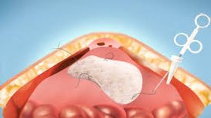 Laparoscopic Repair of Incisional Hernia by Two Ports