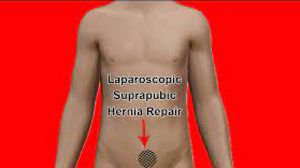 Total Laparoscopic Hysterectomy by Three 5 mm Ports