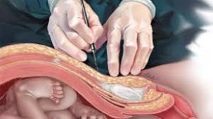 Total laparoscopic hysterectomy (TLH) in patients with previous cesarean section