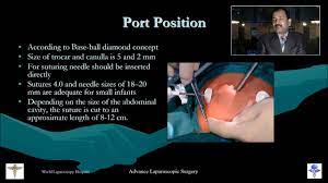 Laparoscopic Choledocotomy Lecture by Dr R K Mishra