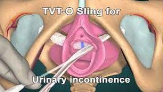 Laparoscopic Ovarian Cystectomy for Right Sided Dermoid Cyst