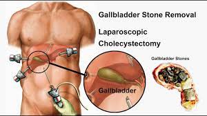 Laparoscopic Myomectomy Lecture by Dr R K Mishra