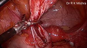 Laparoscopic Removal of Large Subserous Fibroid