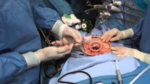 Total laparoscopic hysterectomy (TLH) in patients with previous cesarean section