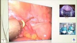 Laparoscopic Resection of a Torted Ovarian Dermoid Cyst