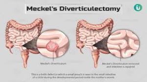 Bilateral Salpingooophorectomy