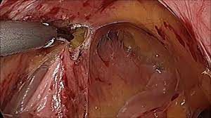 Robotic Bilateral Ovarian Cystectomy