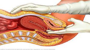 Laparoscopic Myomectomy for Intramural Myoma with Submucosal Extension