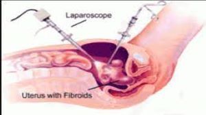 IPOM Umbilical Hernia Repair by VIPRO II Mesh