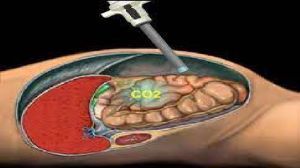 Total Laparoscopic Hysterectomy High Definition Video