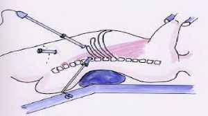 Mishra Knot for Cystic Duct in Acute Cholecystitis