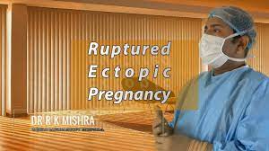 Laparoscopic Management of Ruptured Ectopic Pregnancy