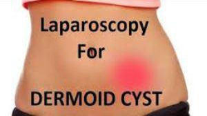 Laparoscopic Surgery for Dermoid Ovarian Cyst